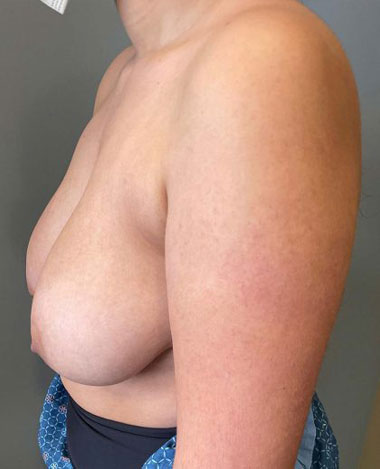 Breast Augmentation Before & After Patient #7162