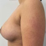Breast Augmentation Before & After Patient #7162
