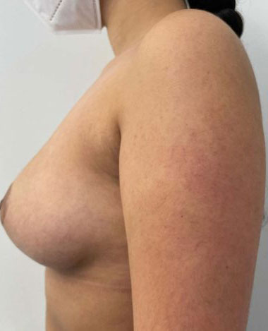 Breast Augmentation Before & After Patient #7162