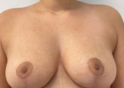 Breast Augmentation Before & After Patient #7162