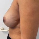 Breast Reconstruction Before & After Patient #7184