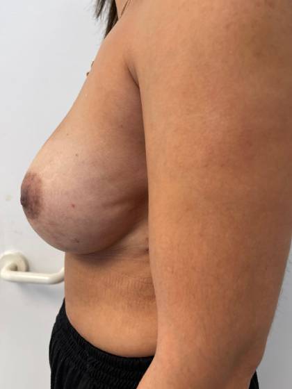 Breast Reconstruction Before & After Patient #7184
