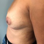 Breast Reconstruction Before & After Patient #7184