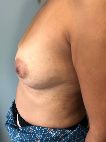 Breast Reconstruction Before & After Patient #7184