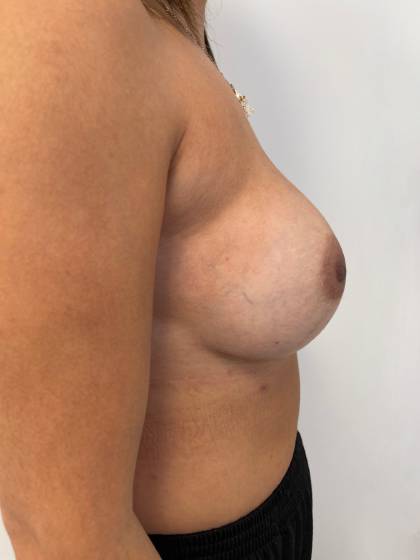Breast Reconstruction Before & After Patient #7184