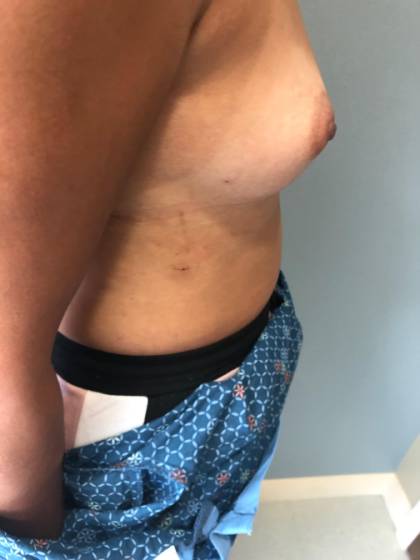 Breast Reconstruction Before & After Patient #7184