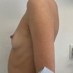 Breast Augmentation Before & After Patient #7238