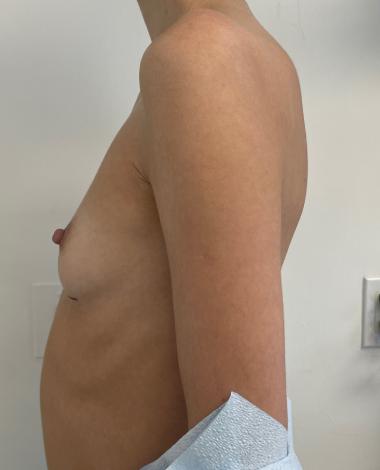 Breast Augmentation Before & After Patient #7238