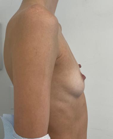Breast Augmentation Before & After Patient #7238
