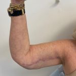 Arm Lift Before & After Patient #7213