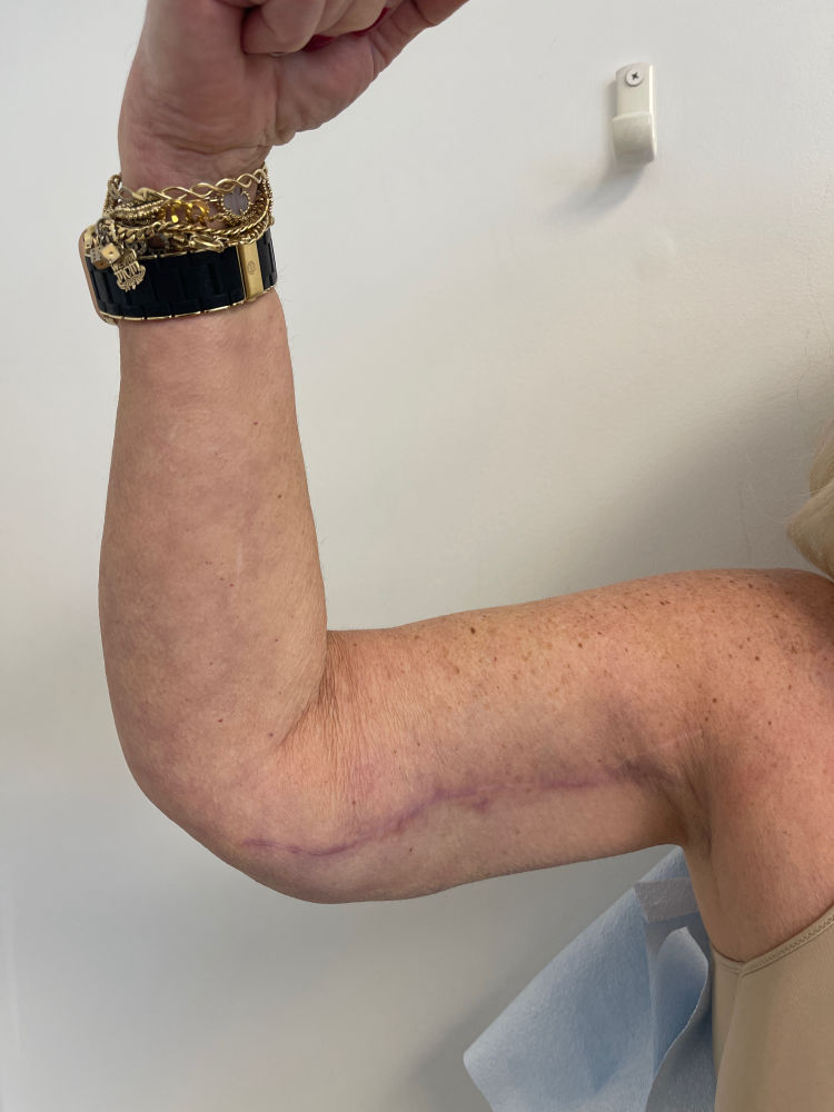 Arm Lift Before & After Patient #7213