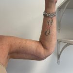 Arm Lift Before & After Patient #7213