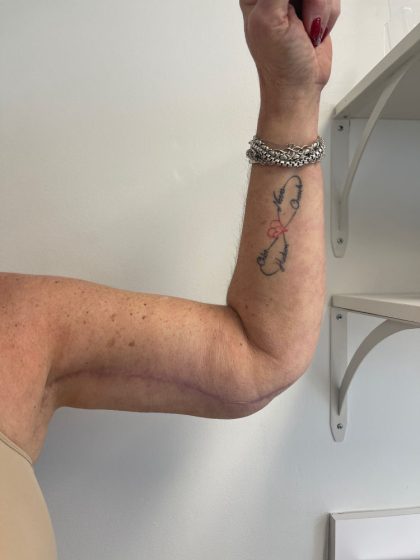 Arm Lift Before & After Patient #7213