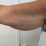 Arm Lift Before & After Patient #7213
