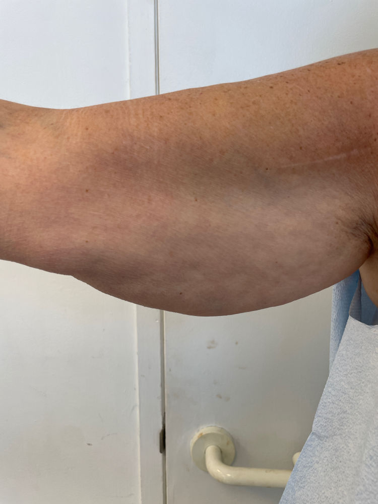 Arm Lift Before & After Patient #7213