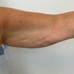 Arm Lift Before & After Patient #7213