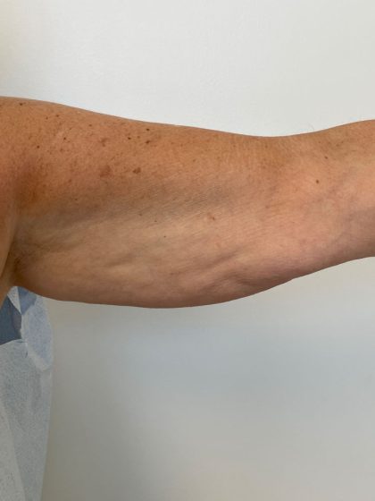 Arm Lift Before & After Patient #7213