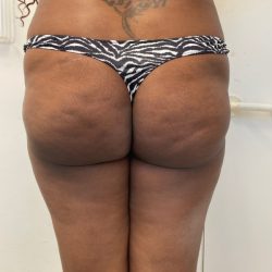 Brazilian Butt Lift Before & After Patient #7382