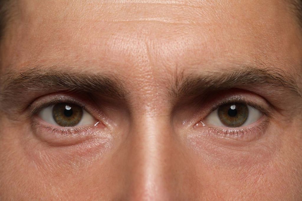Brow Lifts for Men