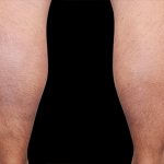 Emsculpt Neo Before & After Patient #7497