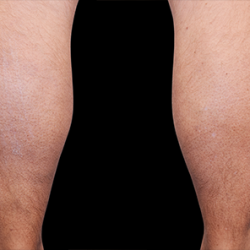 Emsculpt Neo Before & After Patient #7497