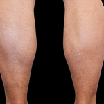 Emsculpt Neo Before & After Patient #7497