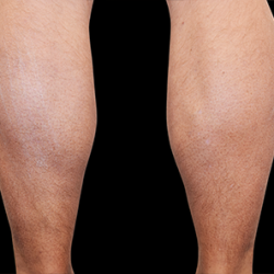 Emsculpt Neo Before & After Patient #7497