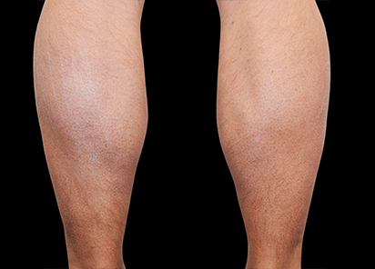 Emsculpt Neo Before & After Patient #7497