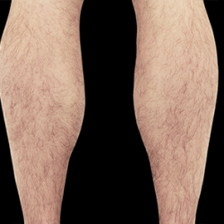 Emsculpt Neo Before & After Patient #7501