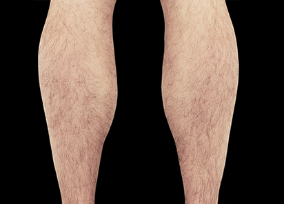 Emsculpt Neo Before & After Patient #7501