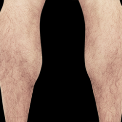 Emsculpt Neo Before & After Patient #7501