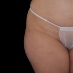Emsculpt Neo Before & After Patient #7503