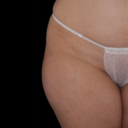 Emsculpt Neo Before & After Patient #7503