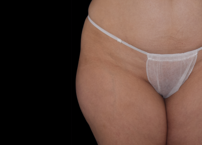 Emsculpt Neo Before & After Patient #7503