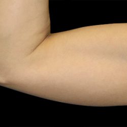 Emsculpt Neo Before & After Patient #7505