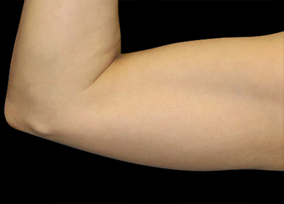 Emsculpt Neo Before & After Patient #7505