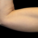 Emsculpt Neo Before & After Patient #7505