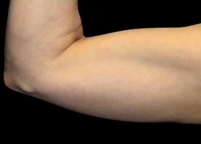 Emsculpt Neo Before & After Patient #7505