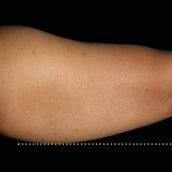 Emsculpt Neo Before & After Patient #7508