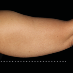 Emsculpt Neo Before & After Patient #7508