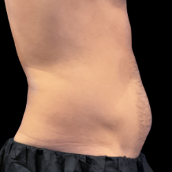 Emsculpt Neo Before & After Patient #7510