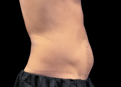 Emsculpt Neo Before & After Patient #7510