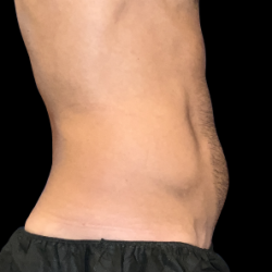 Emsculpt Neo Before & After Patient #7510