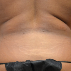 Emsculpt Neo Before & After Patient #7512