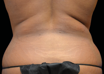 Emsculpt Neo Before & After Patient #7512