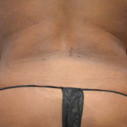 Emsculpt Neo Before & After Patient #7512