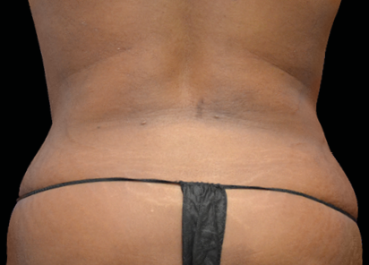 Emsculpt Neo Before & After Patient #7512