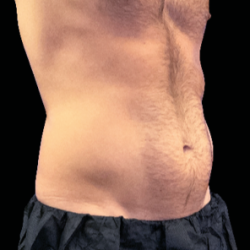 Emsculpt Neo Before & After Patient #7514