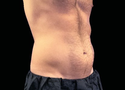 Emsculpt Neo Before & After Patient #7514