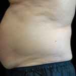 Emsculpt Neo Before & After Patient #7482
